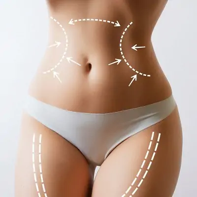 The Best Liposuction Surgeon in Dubai: What to Expect from Your Consultation