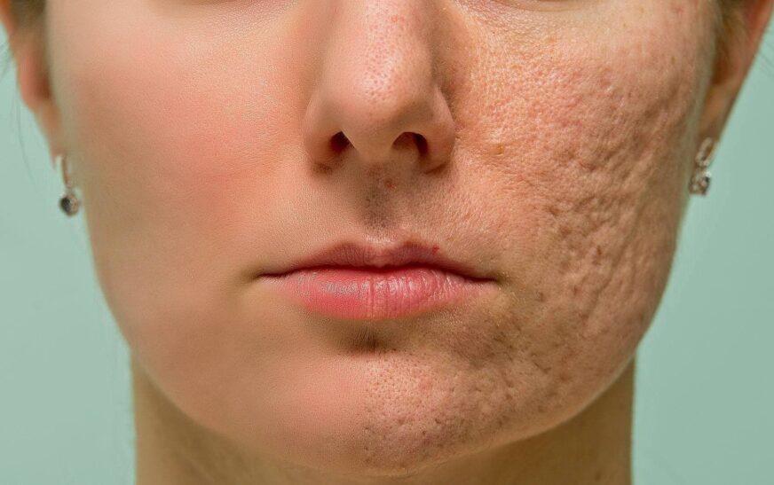 The Science of Acne: What Happens Beneath Your Skin