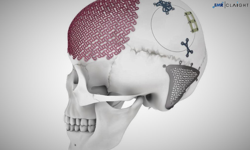 Global Craniomaxillofacial Implants Market Share, Analysis, Segments, Growth, Trends & Forecast | 2024 – 2032