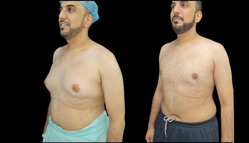 Luxury Recovery and Aftercare: Post-Gynecomastia Surgery Retreats with the Best Doctors in Dubai