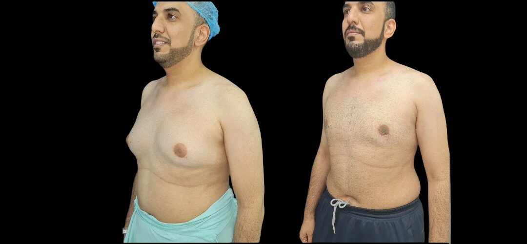 Luxury Recovery and Aftercare: Post-Gynecomastia Surgery Retreats with the Best Doctors in Dubai