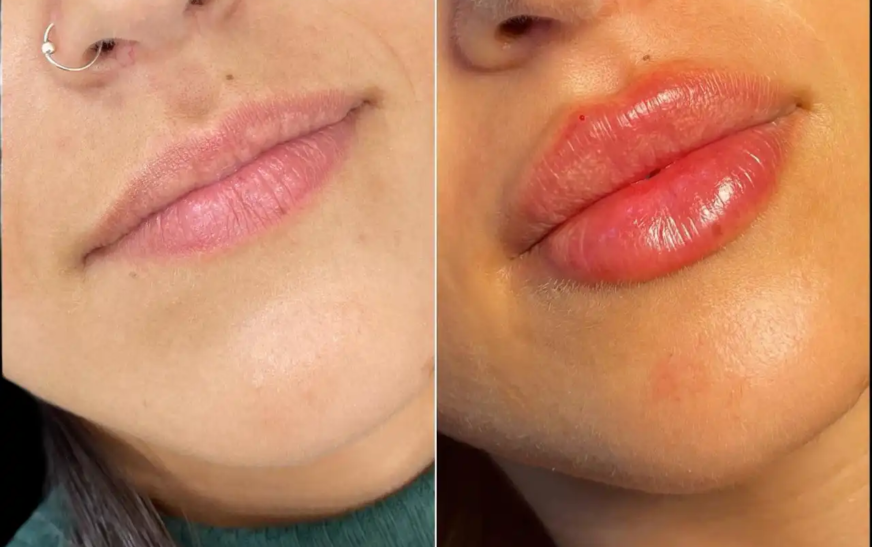 Juvederm Fillers