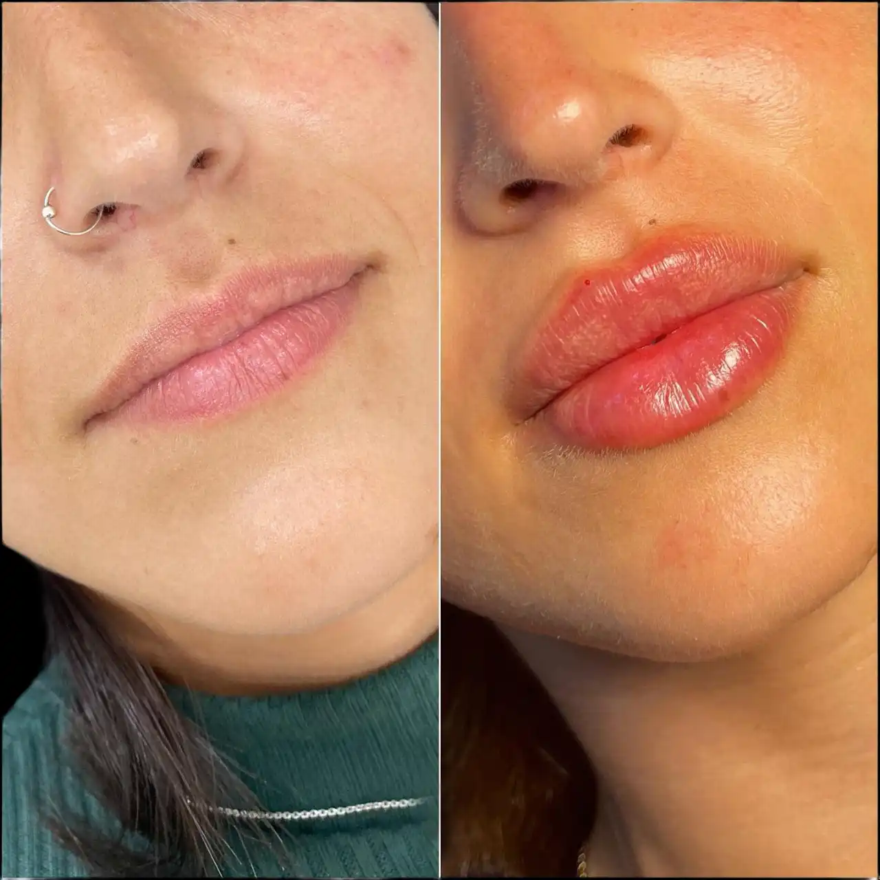 How the Best Aesthetics Clinic in Dubai Ensures Safe Juvederm Filler Treatments