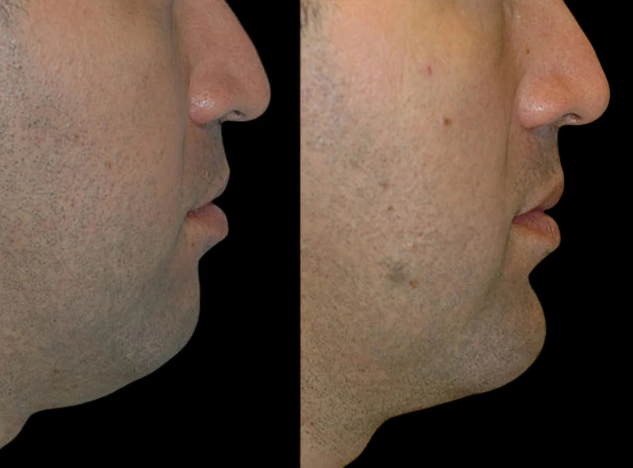 Comparing Prices: The Best Aesthetics Clinic in Dubai for Jawline Fillers