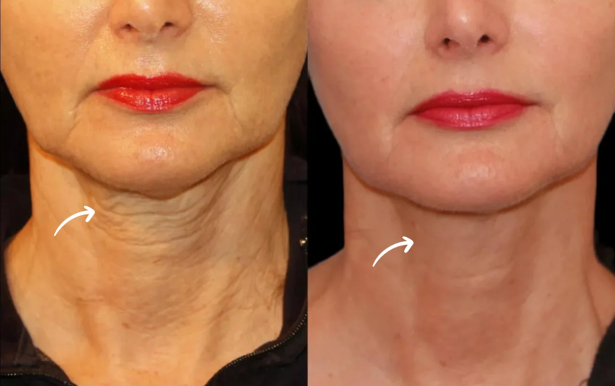 Why Choose the Best Plastic Surgeon in Dubai for Sculptra Treatments?