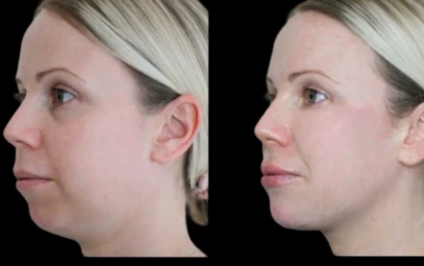 Why Choose the Best Aesthetics Clinic in Dubai for Chin Fillers Over Other Options?