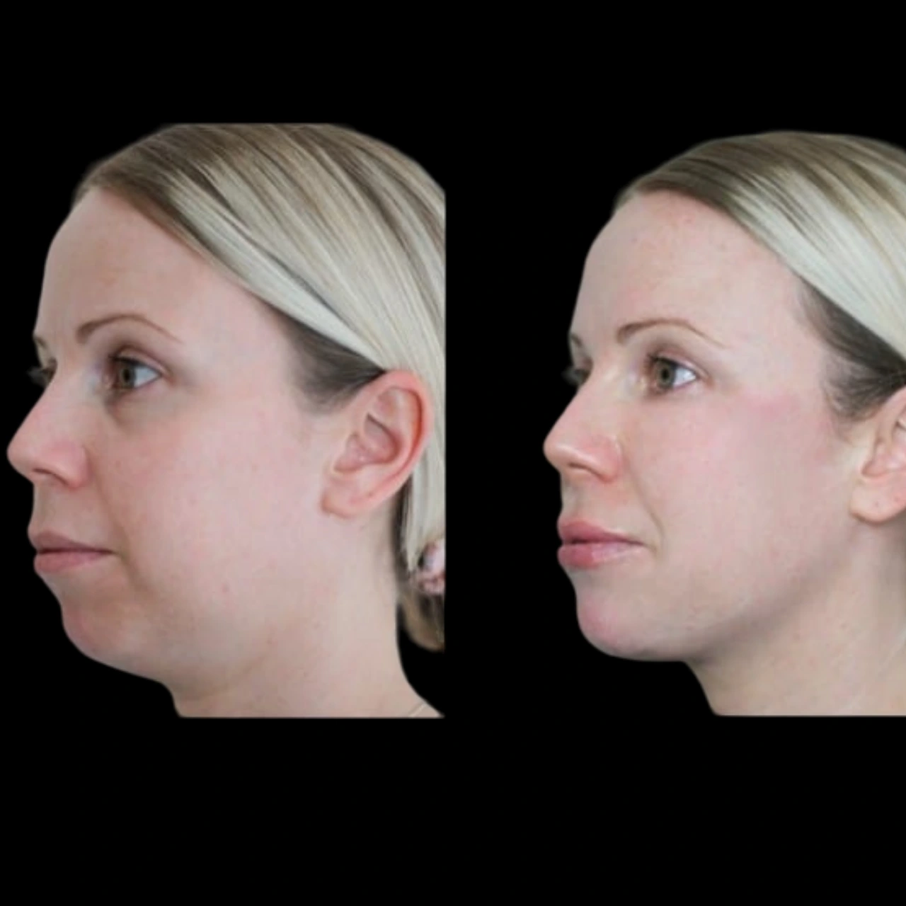 Why Choose the Best Aesthetics Clinic in Dubai for Chin Fillers Over Other Options?