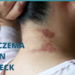 eczema under the neck