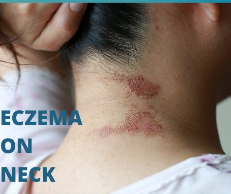 eczema under the neck