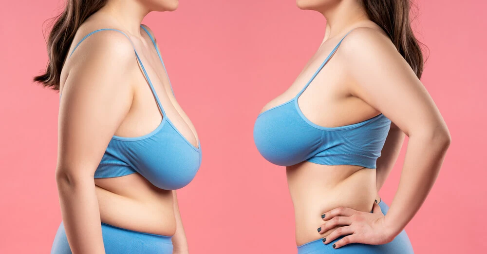 How Can I Track and Measure the Progress of My Recovery After Breast Reduction Surgery? Tips from the Best Doctors in Dubai