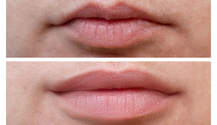 How a Botox Lip Flip Course Can Help You Start Your Own Beauty Business