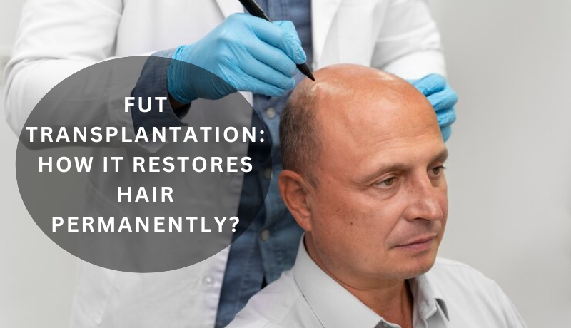 FUT Transplantation: How It Restores Hair Permanently?