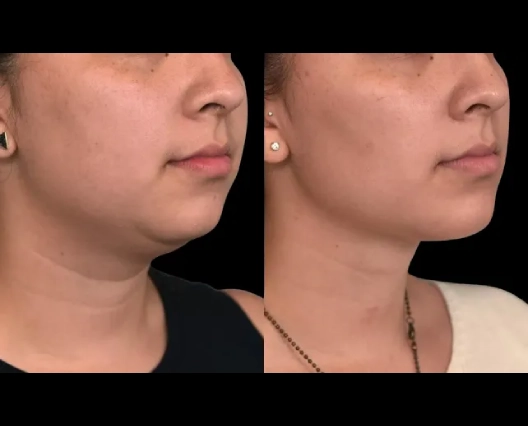 How to Sleep Comfortably After Double chin removal Surgery in dubai