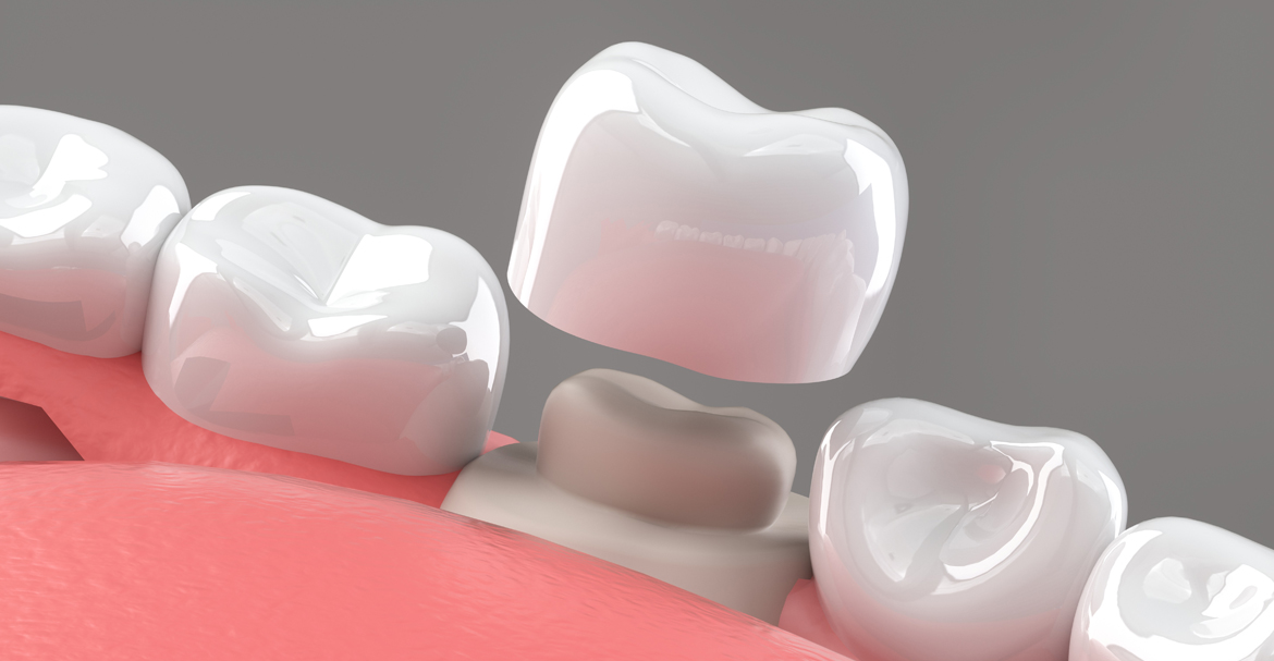 Your Guide to the Types of Dental Crowns Available in Milpitas