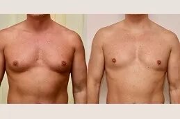 Gynecomastia in Dubai: Advanced Techniques for Scar-Free Results