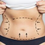 Liposuction in Dubai