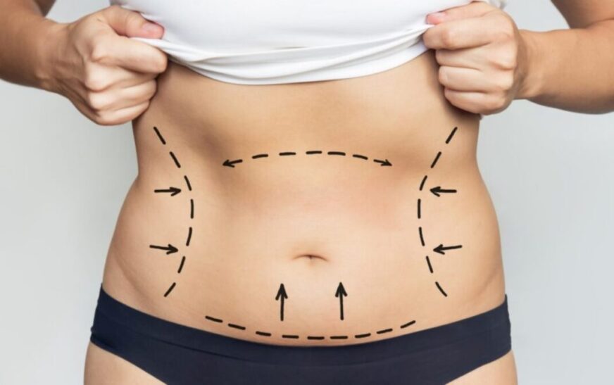 Why Compression Garments Are Crucial Following Full Body Liposuction in Dubai