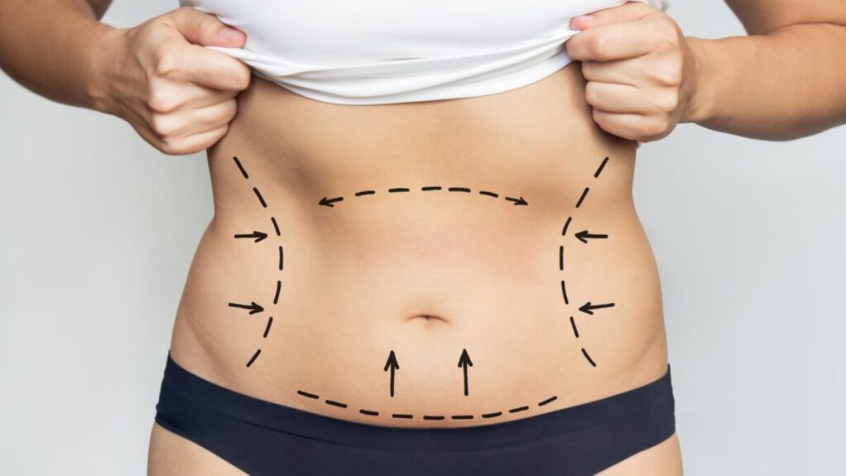 Why Compression Garments Are Crucial Following Full Body Liposuction in Dubai