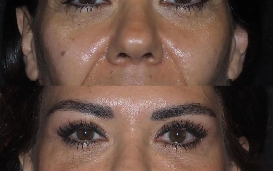 How to Avoid Scarring After Eye bag removal Surgery in dubai