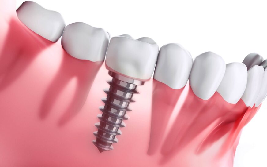 Finding the Best Dentist in La Mirada for Affordable Dental Implants