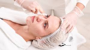 Advanced Acne Treatment in Guwahati: Customized Laser and Skincare Solutions | Essence Skin Clinic