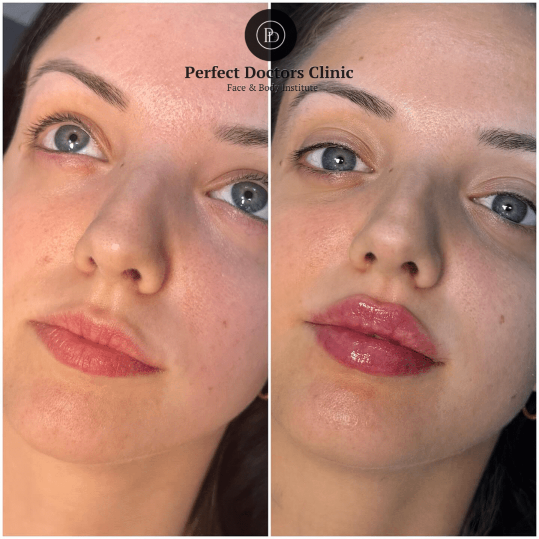 Juvederm for Lip Hydration: Best Plastic Surgeon in dubai’s Insights