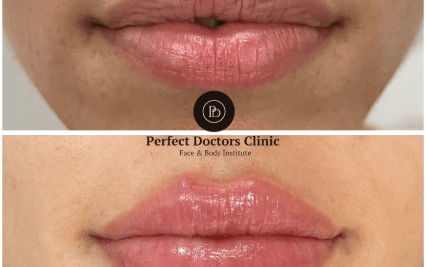 Best Doctors in dubai Explain the Science Behind Juvederm