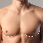 gynecomastia in dubai