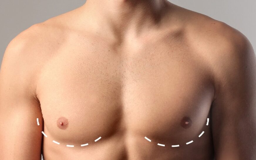 gynecomastia in dubai