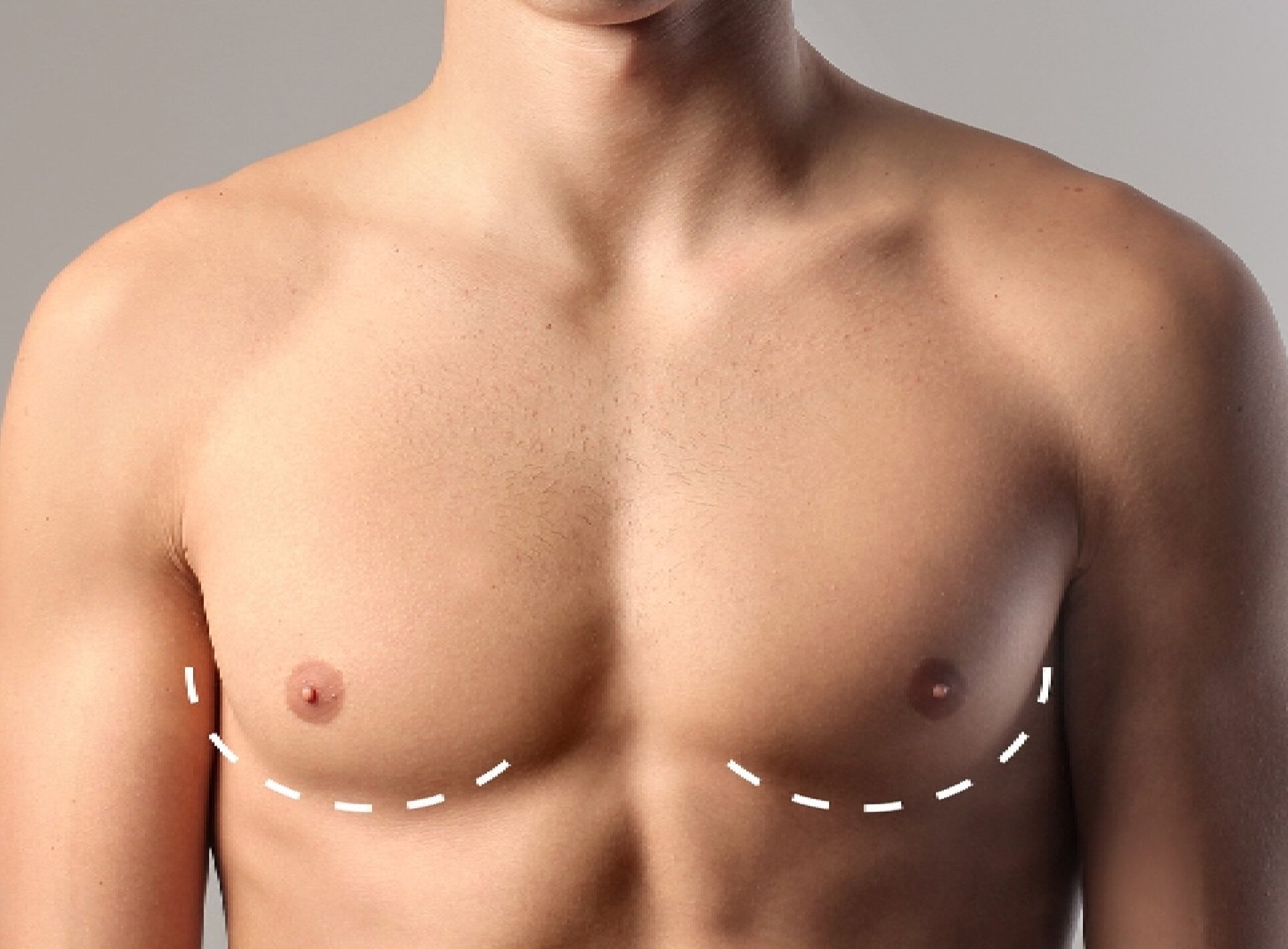 Best Gynecomastia Surgeons in dubai: Achieve the Look You Deserve