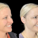 Botox Treatments in Dubai – Achieve a Fresh and Vibrant Appearance