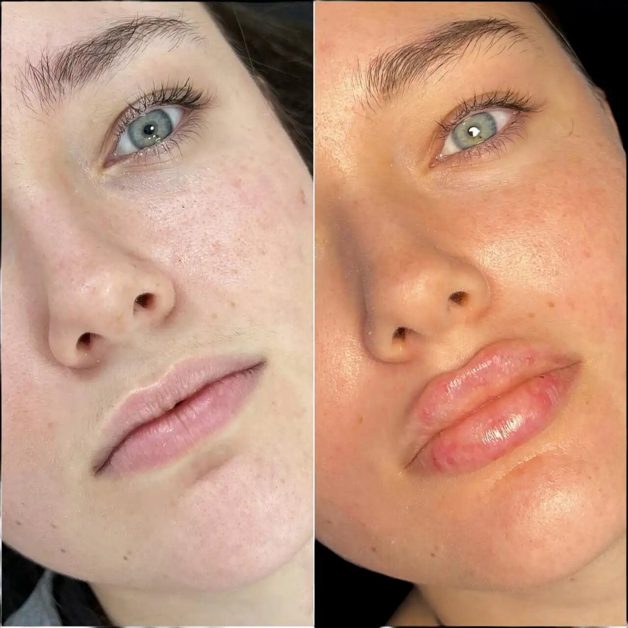 Exploring the Benefits of Fillers Treatment in Dubai for a Youthful Look