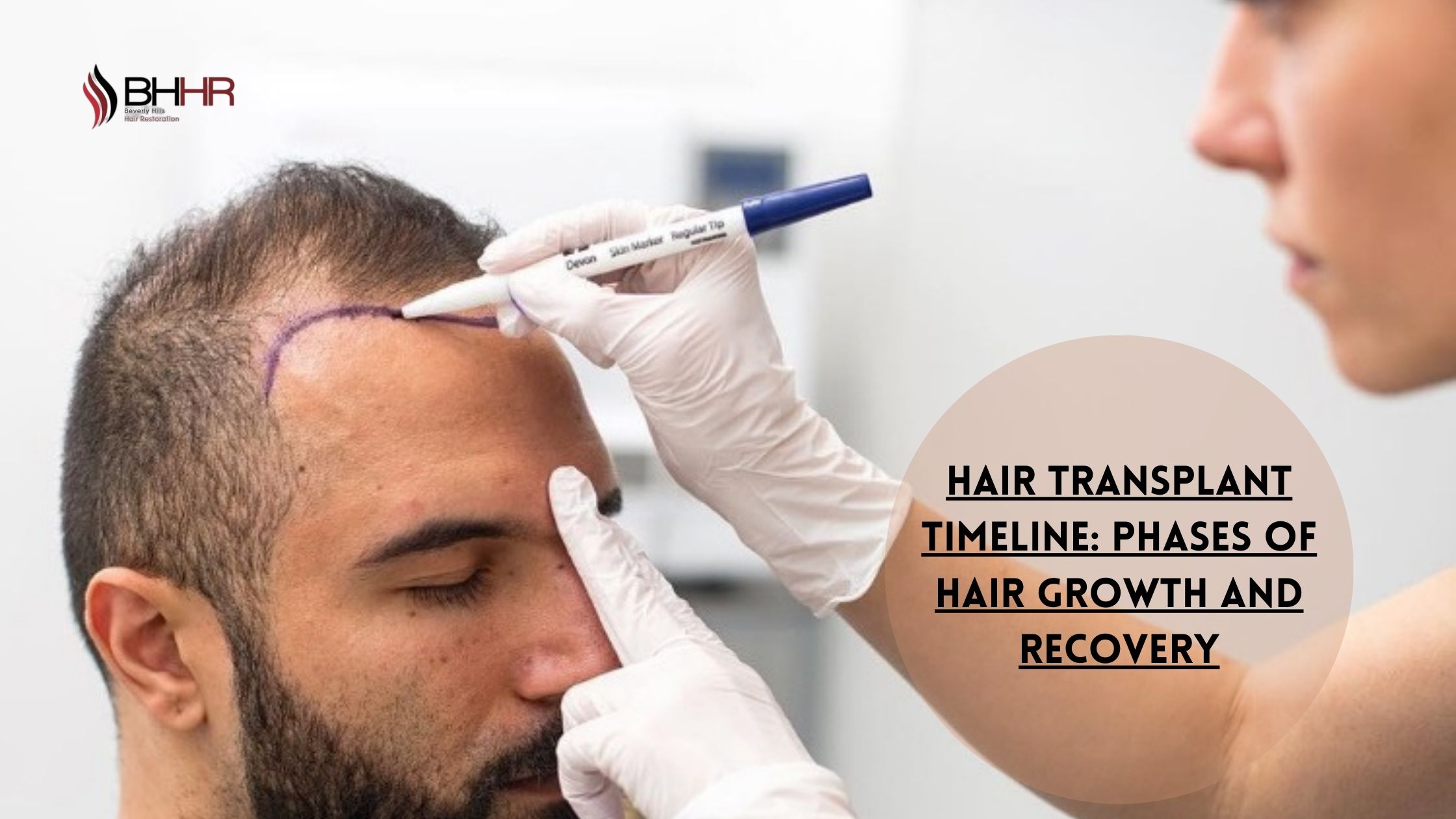 Hair Transplant Timeline: Phases of Hair Growth and Recovery