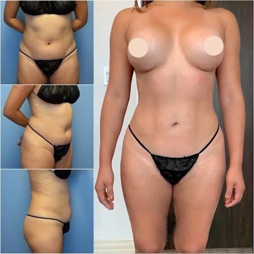 Why the Best Body Contouring Surgeon in dubai is Your Best Investment for Aesthetic Goals