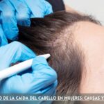 Tratamiento Para La Caida Del Cabello