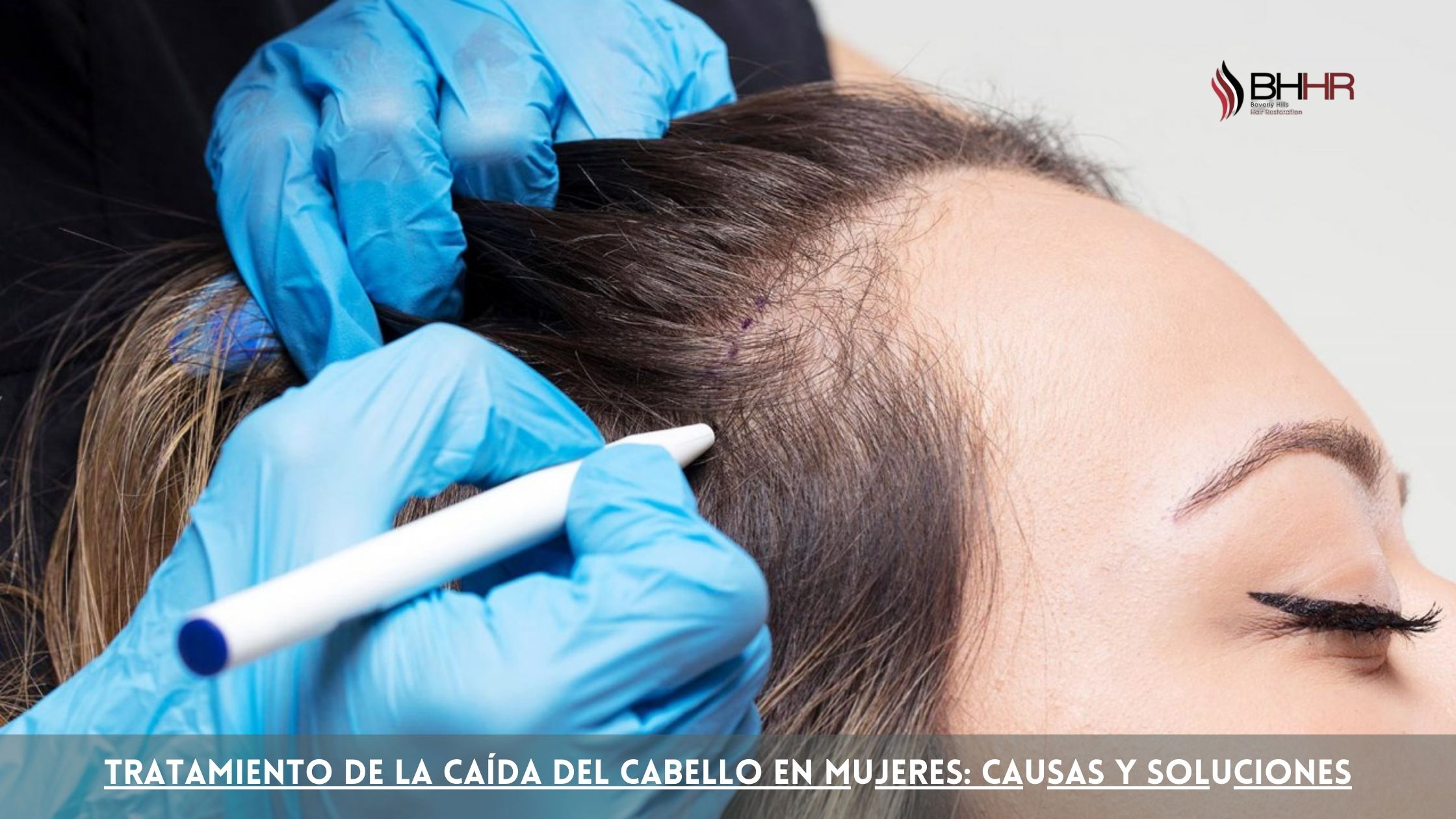 Tratamiento de la caída del cabello en mujeres: causas y soluciones