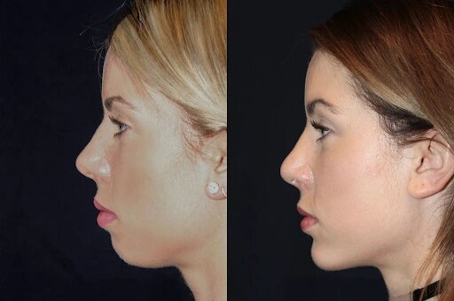 Quick and Easy Chin Fillers Treatment in Dubai