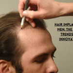 hair implants for men