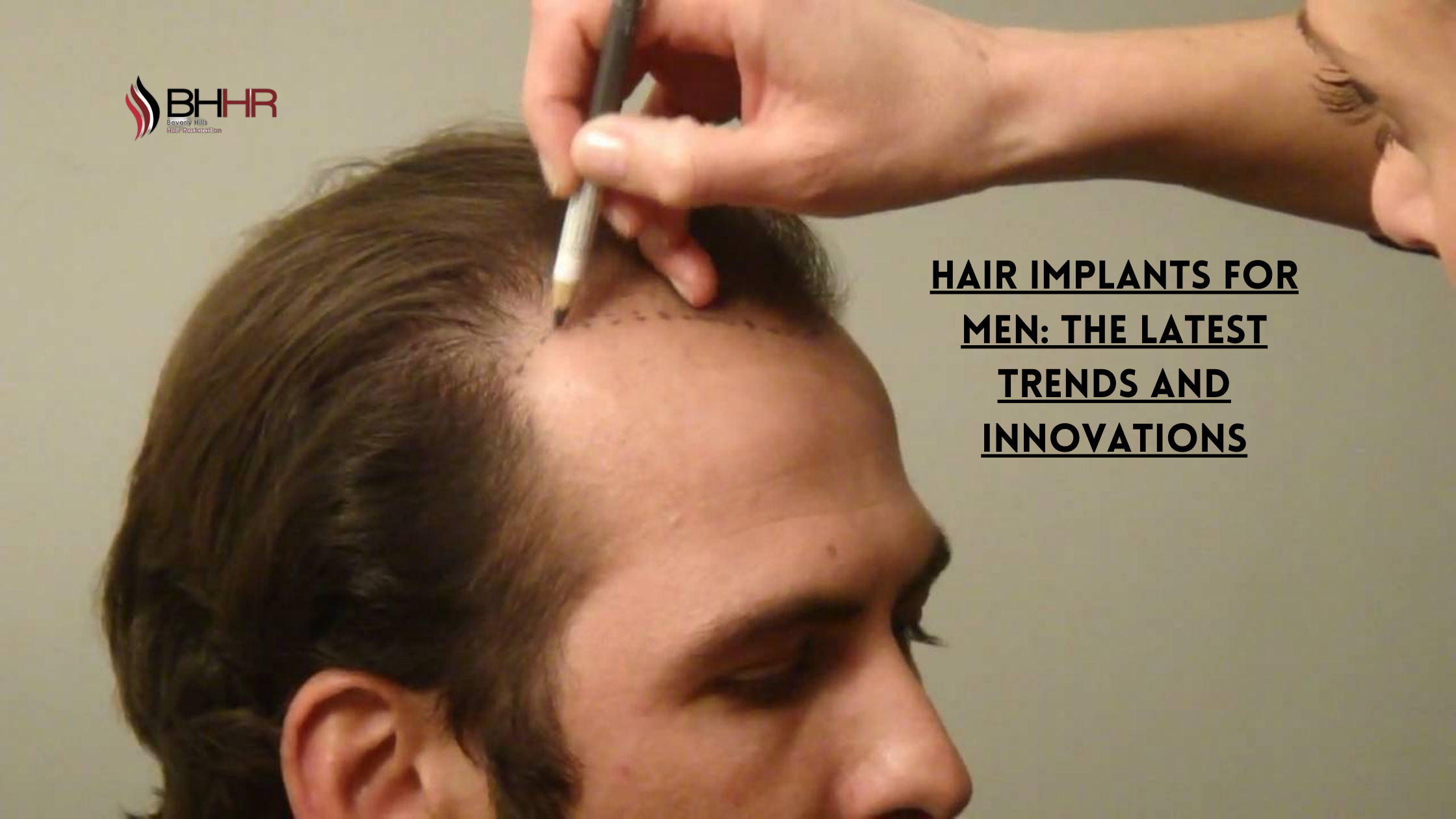 Hair Implants for Men: The Latest Trends and Innovations