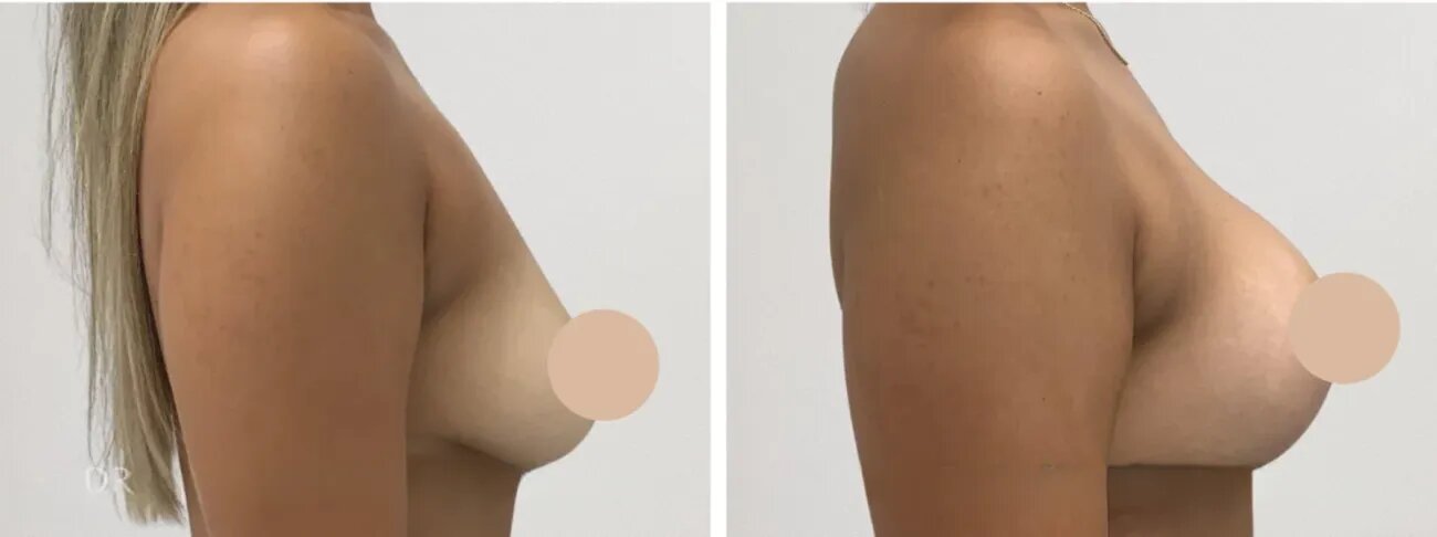 Can a Breast Lift in Dubai Improve Your Breast Shape Without Implants?