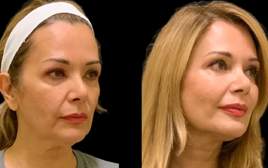 Best Plastic Surgeon in Dubai: Cheek Filler Results for Different Face Shapes