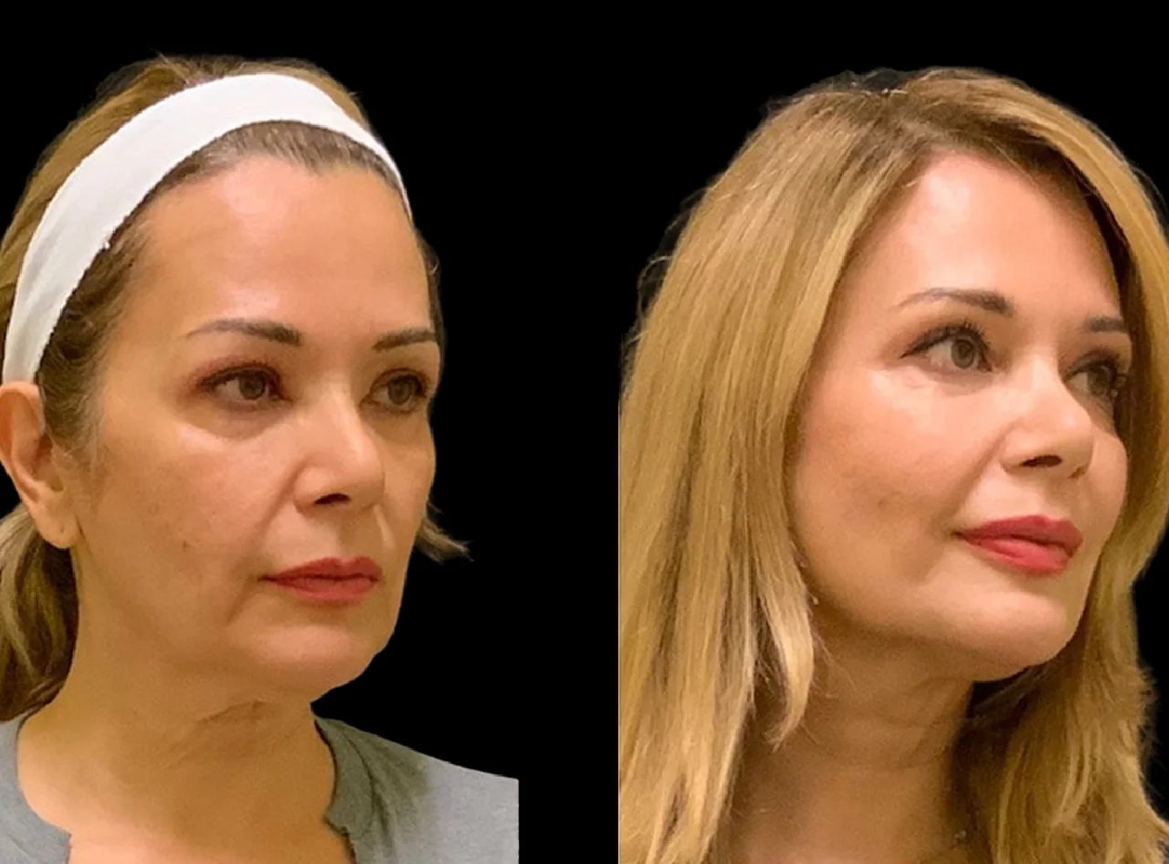 Best Plastic Surgeon in Dubai: Cheek Filler Results for Different Face Shapes