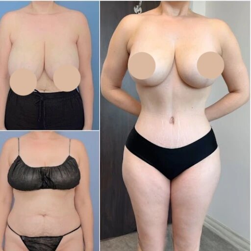 Best Tummy Tuck Surgeons in dubai: What Sets Them Apart?