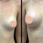 Best breast augmentation surgeons in Dubai