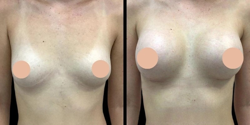 How Breast Augmentation in Dubai Can Enhance Your Confidence and Shape