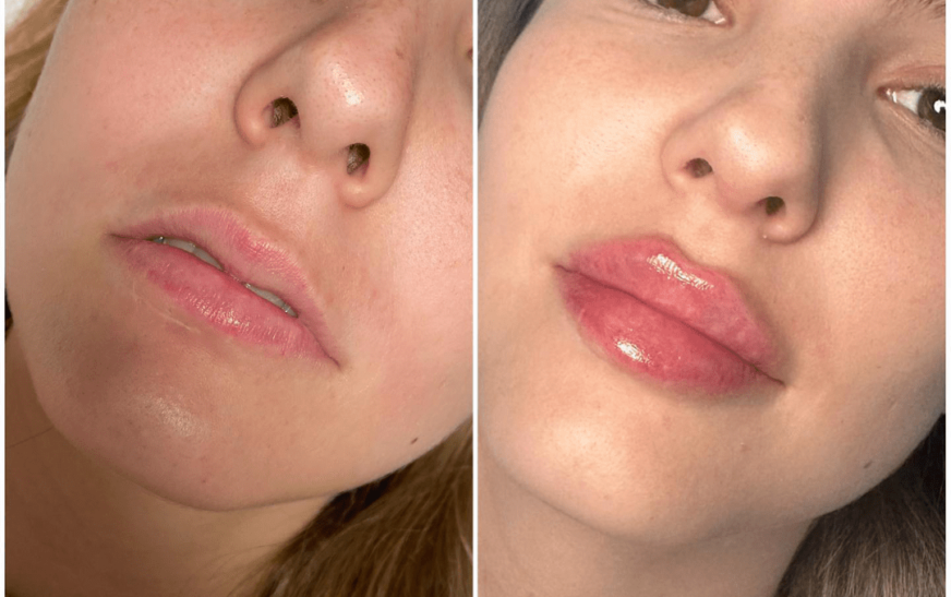 The Advantages of Juvederm Over Other Fillers at the Best Aesthetic Clinic in dubai