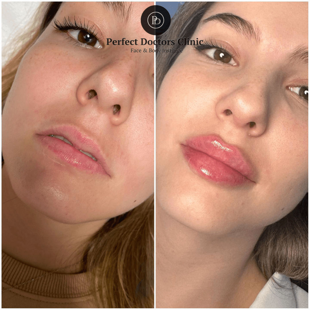 The Advantages of Juvederm Over Other Fillers at the Best Aesthetic Clinic in dubai