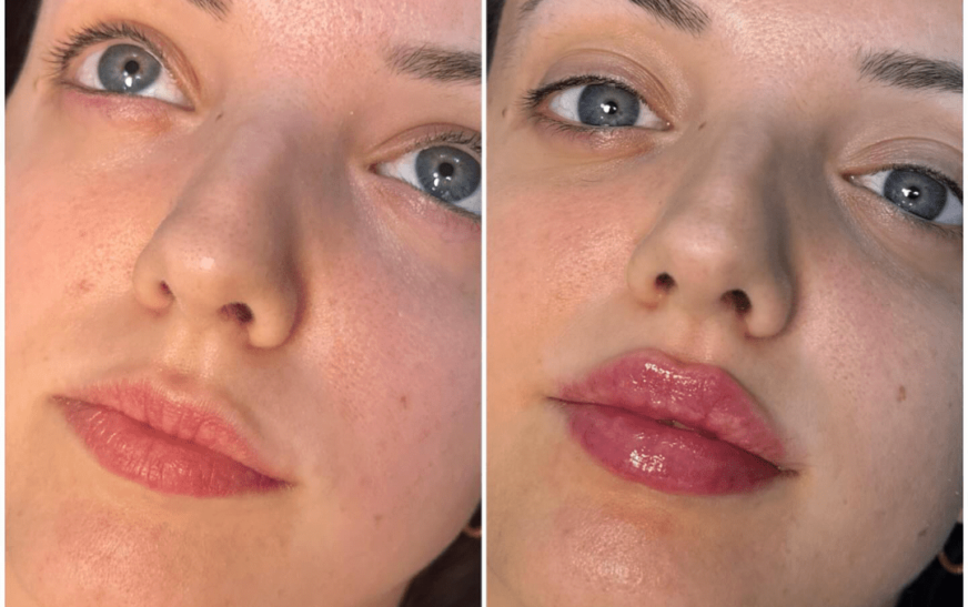 Juvederm for Anti-Aging: Best Plastic Surgeon in dubai Reveals Its Secrets