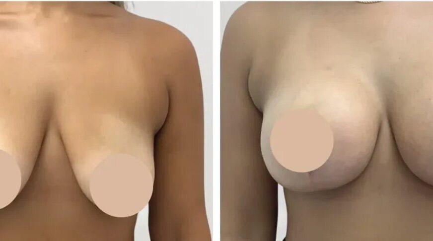 Understanding Breast Reduction Recovery and Healing Time in Dubai