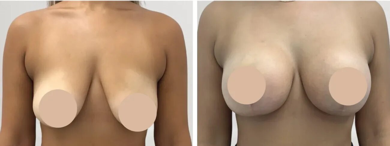 Understanding Breast Reduction Recovery and Healing Time in Dubai